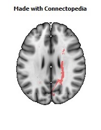 Cerebral_peduncle_R080