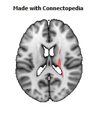 Cerebral_peduncle_R090