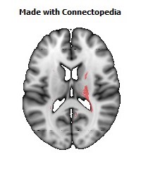 Cerebral_peduncle_R092