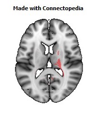 Cerebral_peduncle_R094