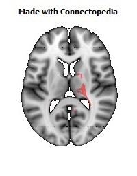 Cerebral_peduncle_R096