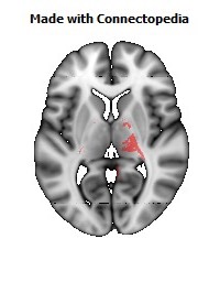 Cerebral_peduncle_R102