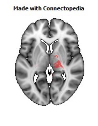 Cerebral_peduncle_R104