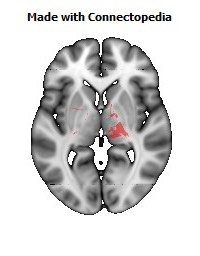 Cerebral_peduncle_R106