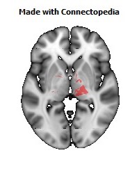 Cerebral_peduncle_R108