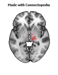 Cerebral_peduncle_R110