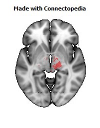 Cerebral_peduncle_R112