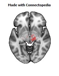 Cerebral_peduncle_R114