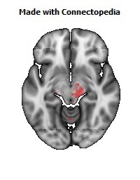 Cerebral_peduncle_R118