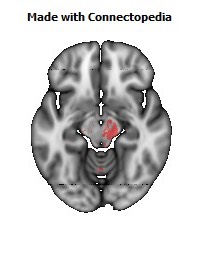 Cerebral_peduncle_R120