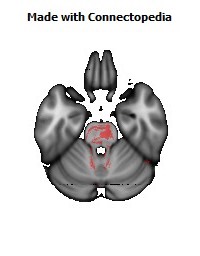 Cerebral_peduncle_R134