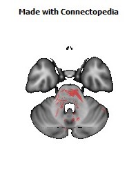 Cerebral_peduncle_R140