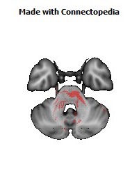 Cerebral_peduncle_R142