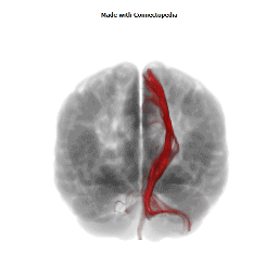 Cerebral Peduncle