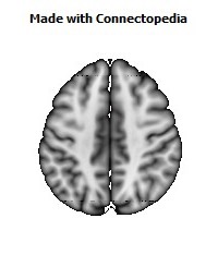 Cingulum_(cingulate_gyrus)_R064