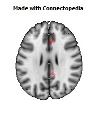 Cingulum_(cingulate_gyrus)_R080