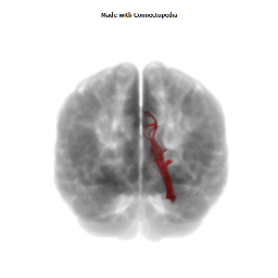 Cingular (Temporal) Fasciculus