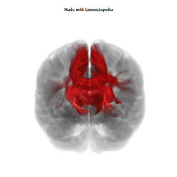 Corpus Callosum