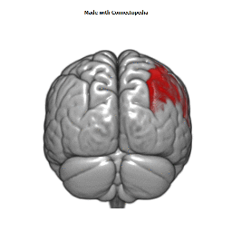 Deep Middle Cerebral Vein Cortical Extent