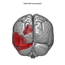 Sigmoid Sinus Cortical Extent