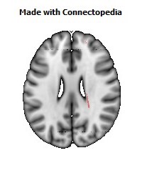 Corticospinal_tract_R082