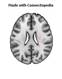 Corticospinal_tract_R084