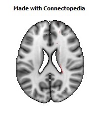 Corticospinal_tract_R086