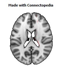 Corticospinal_tract_R088