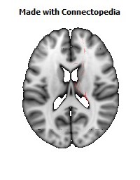 Corticospinal_tract_R090