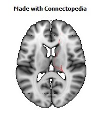 Corticospinal_tract_R094