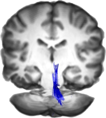 Superior Cerebellar Peduncle