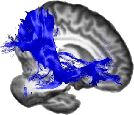 Posterior Corona Radiata