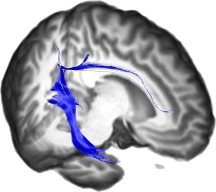 Cingular (Temporal) Fasciculus