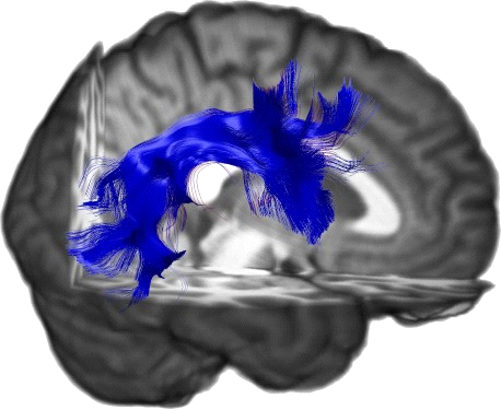 Superior Longitudinal Fasciculus