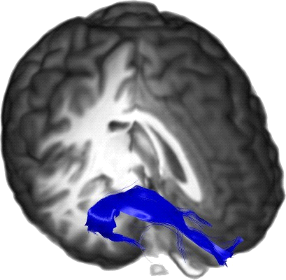 Uncinate Fasciculus