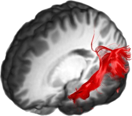 Inferior Longitudinal Fasciculus