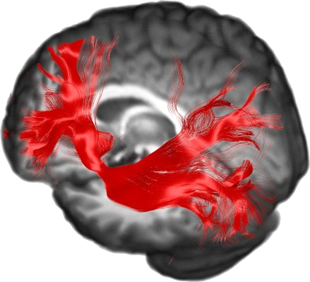 Inferior Fronto-Occipital Fasciculus