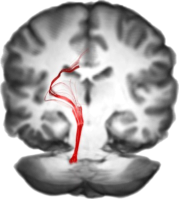 Spino-Thalamic Tract