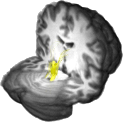 Posterior Comissure