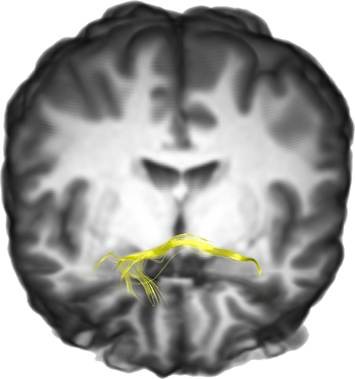 Anterior Commissure