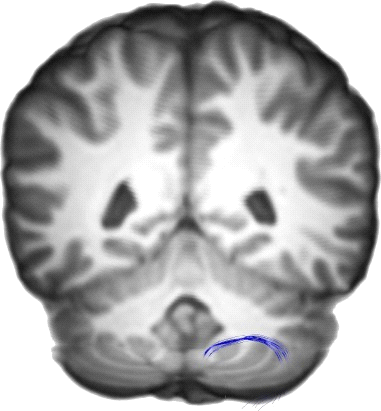 Inferior Cerebellar Peduncle