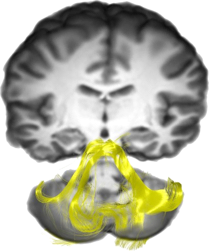 Middle Cerebellar Peduncle