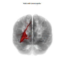 Inferior Fronto-Occipital Fasciculus