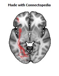 Inferior_Fronto_Occipital_L112