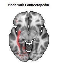 Inferior_Fronto_Occipital_L116