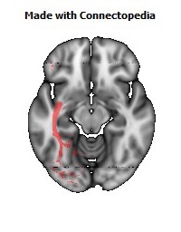 Inferior_Fronto_Occipital_L120