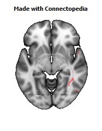 Inferior_Longitudinal_L114