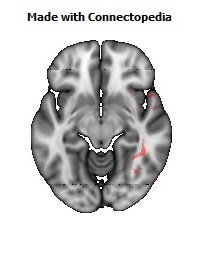 Inferior_Longitudinal_L118