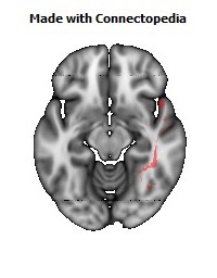 Inferior_Longitudinal_L120