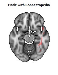 Inferior_Longitudinal_L122